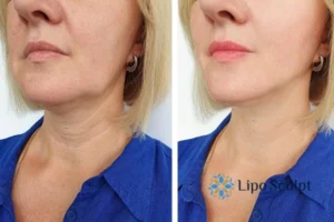 Double chin before and after Hi-Fu treatment 4 Book your double chin treatment East Retford today! We are here to help!