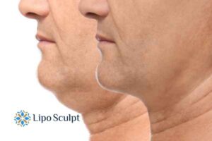 Double chin before and after Hi-Fu treatment 2 Double chin treatment East Retford from Lipo Sculpt - feel more confident today!