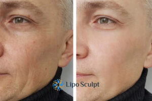 How to Fight Aging Symptoms 3 Fight Aging Symptoms East Retford With HIFU and Morpheus8 Today!