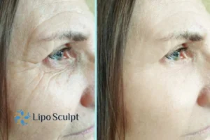 How to Fight Aging Symptoms 2 Do you want to Fight Aging Symptoms East Retford? Contact Lipo Sculpt today!