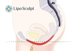 Pelvic Floor Chair Therapy 1 Pelvic Floor Chair Therapy East Retford to treat incontinence.