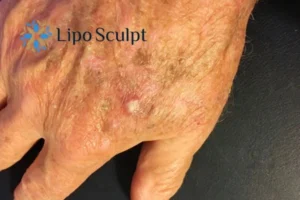 Best Actinic Keratoses Removal 2 Improve your wellbeing and health with Actinic Keratoses East Retford removal.treatment