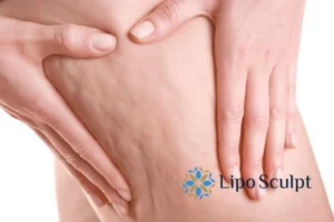 CoolSculpting for Legs: The Innovative Approach to Redefining Your Legs 5 Start your journey today book your coolsculpting treatment East Retford online today!